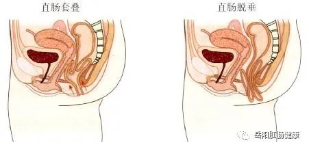 市肛肠中心治疗“盆底松弛型疾病”有妙招